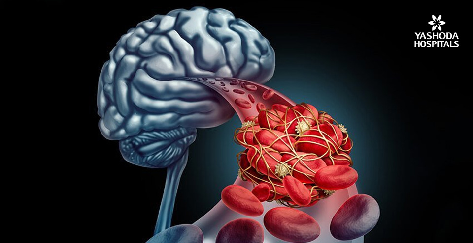 A thick, waxy plaque can limit, or completely obstruct, blood flow to the brain