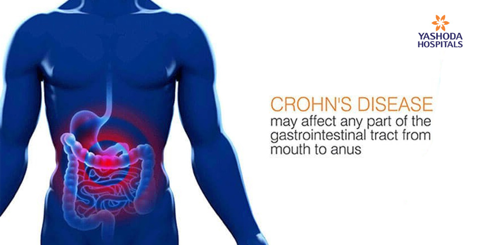 GERD (gastroesophageal reflux disease) may lead to Barrett’s esophagus