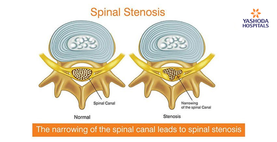 Spinal stenosis – Narrowing on Narrow Spaces of Your Spine