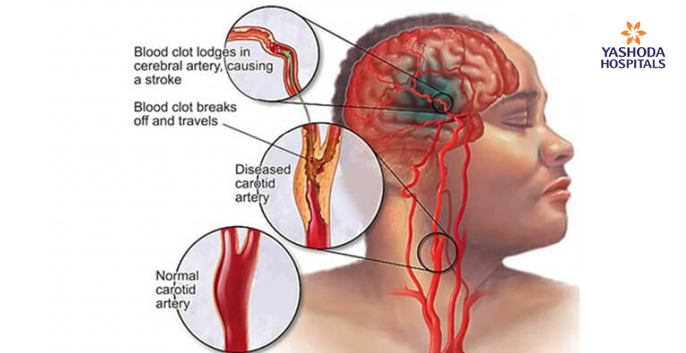 How to treat Acute Ischemic stroke using Intra-arterial Thrombolytic Therapy effectively?