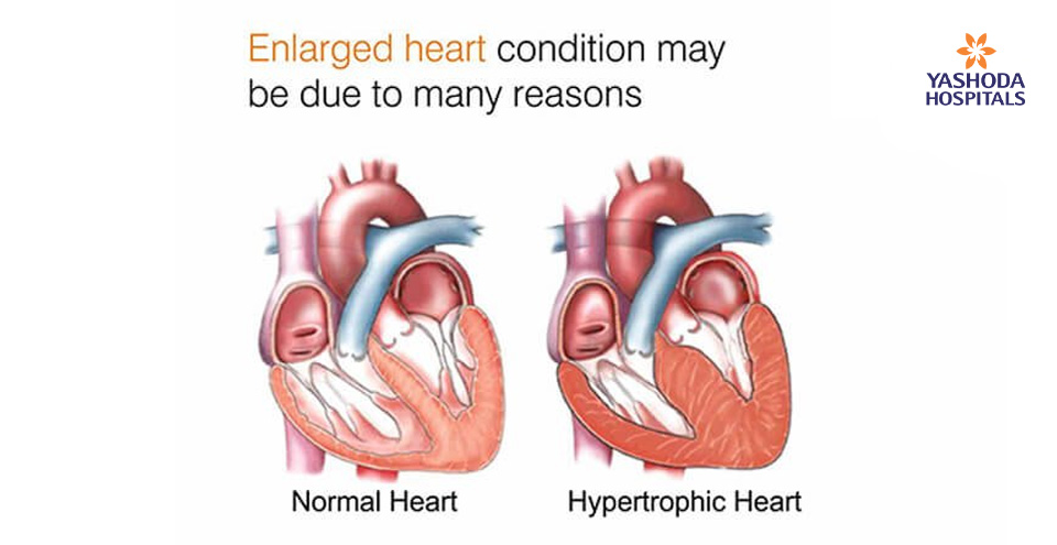 Enlarged Heart: What are its causes?