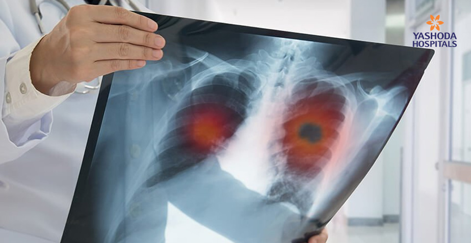 Acute and Chronic Respiratory Failure