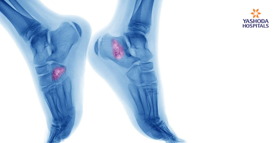 Bone Cancer Usually affects the long bones that make up arms and legs