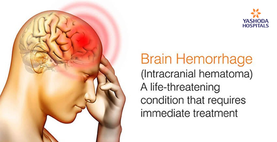 How to treat Brain Hemorrhage immediately?