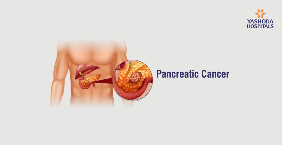 Pancreatic Cancer: Delayed or poor prognosis is the leading cause of cancer death