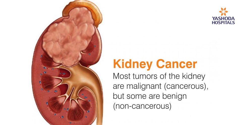 Are all tumors of kidney cancerous?