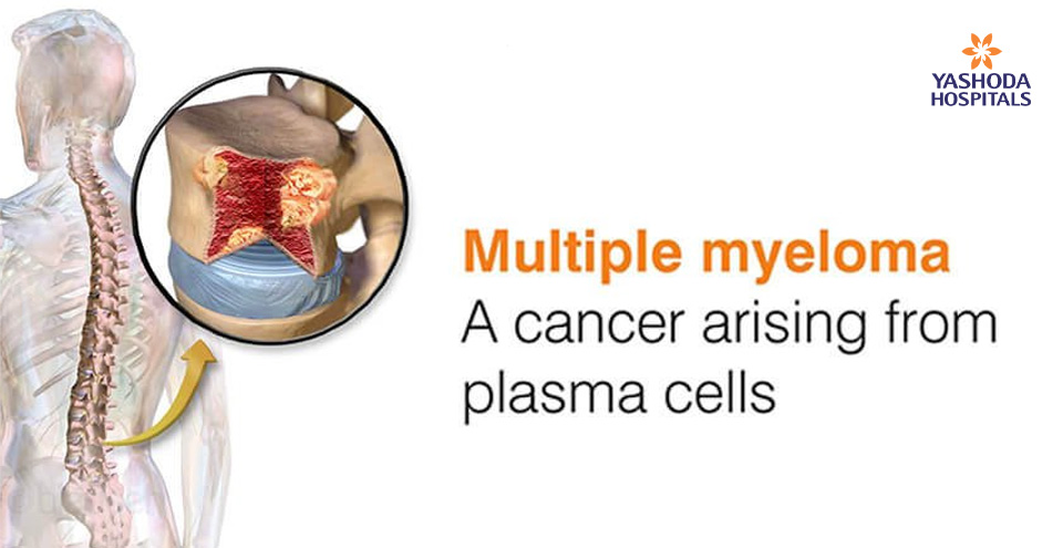 How to diagnose and treat Multiple Myeloma?