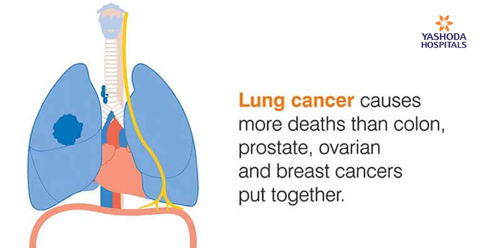 Lung cancer causes more deaths than colon, prostate, ovarian and breast cancers put together