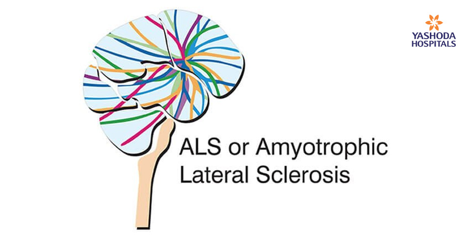 ALS or Amyotrophic Lateral Sclerosis