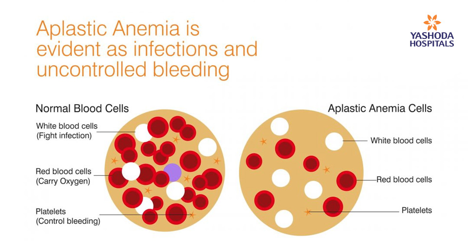 Aplastic Anemia is evident as infections and uncontrolled bleeding