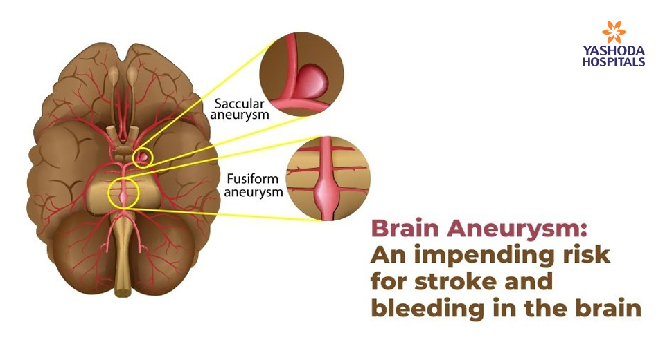 Brain Aneurysm: An impending risk for stroke and bleeding in brain