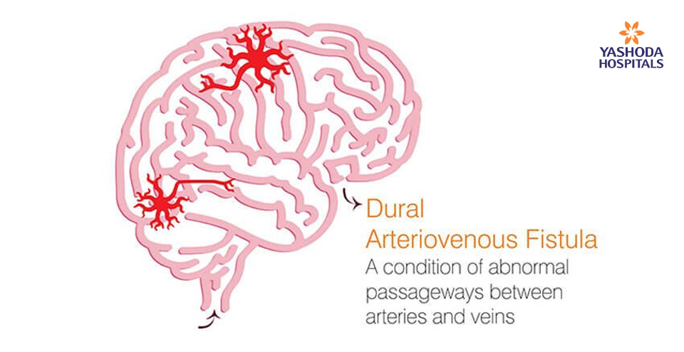 Dural Arteriovenous Fistula