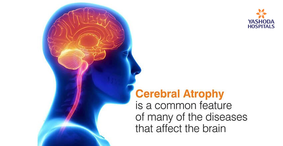 Cerebral atrophy is a common feature of many of the diseases that affect the brain