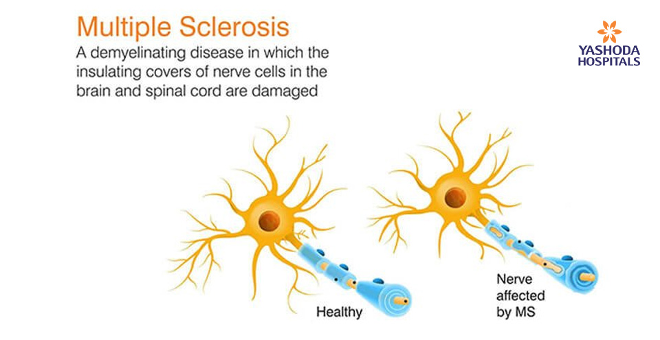 Multiple sclerosis: A debilitating disease of the nerve