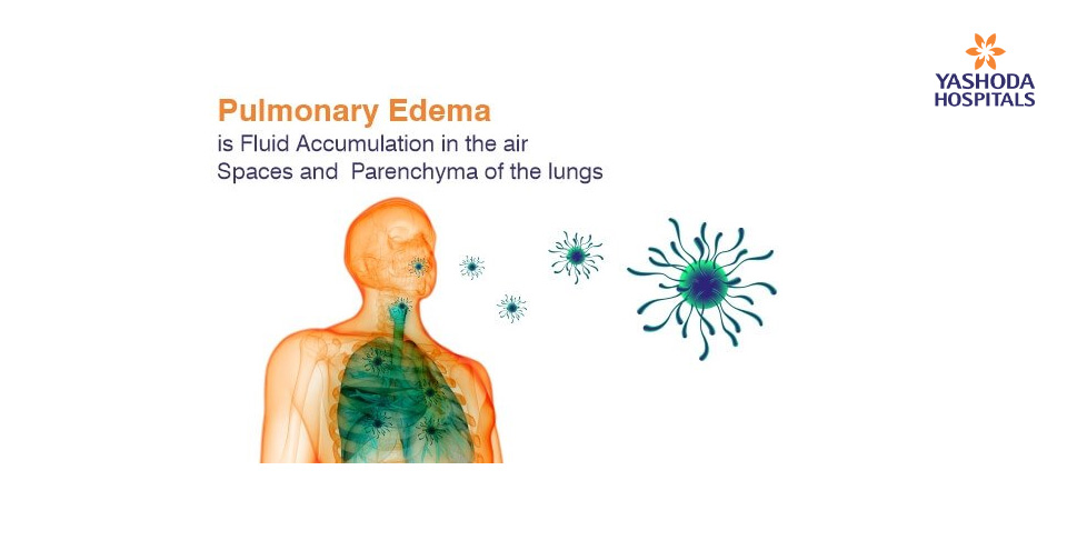 Pulmonology Edema: Excess fluid in the air spaces and parenchyma of the lungs