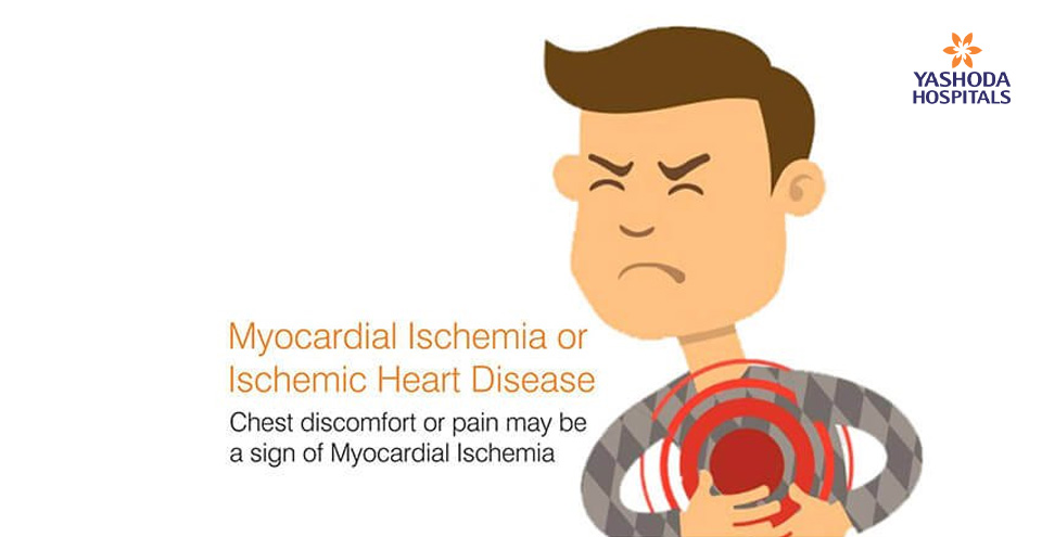 Don’t ignore discomfort or pain in chest, a sign of myocardial ischemia