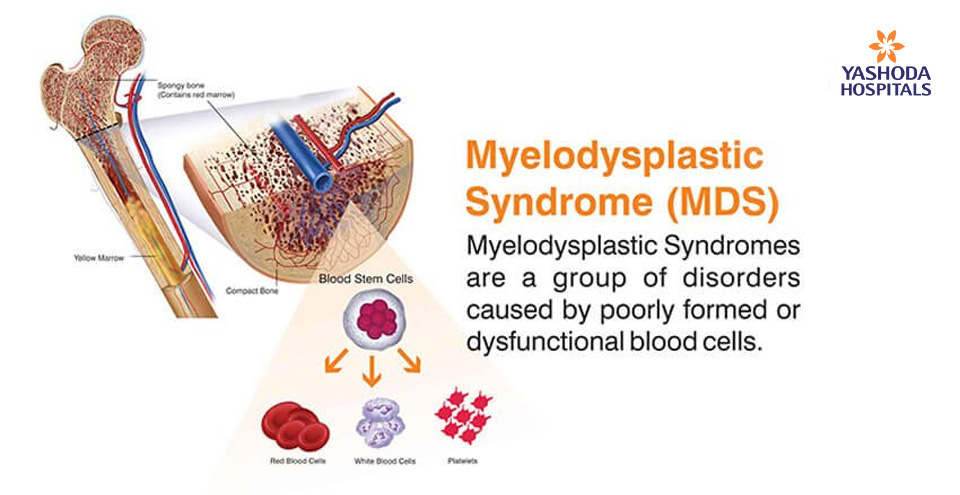 How to diagnose and treat Myelodysplastic Syndrome?