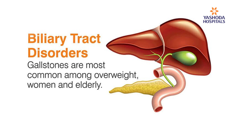 How to treat Gallstones?