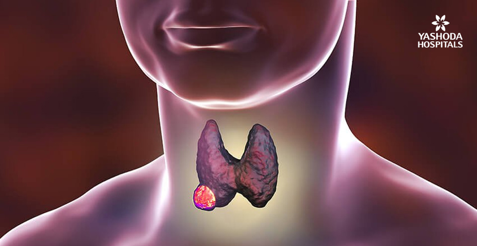 If you have a lump in your neck, it could be thyroid cancer