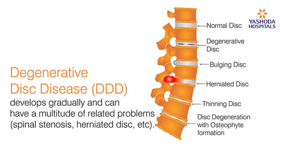 Degenerative Disc Disease develops gradually and can have a multitude of related problems