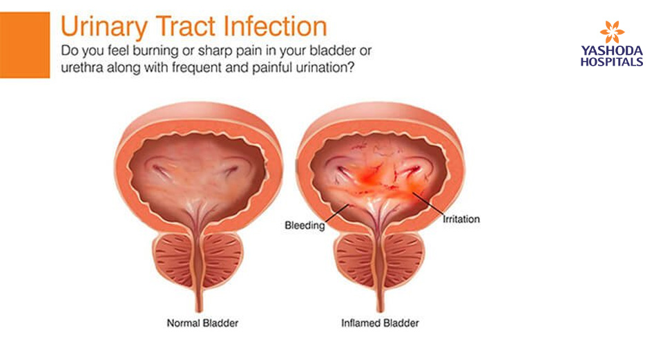 Do you feel burning or sharp pain in your bladder or urethra?