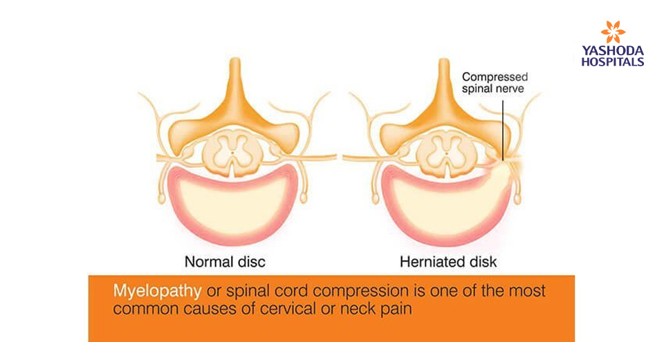 Myelopathy or spinal cord compression is one of the most common causes of cervical or neck pain