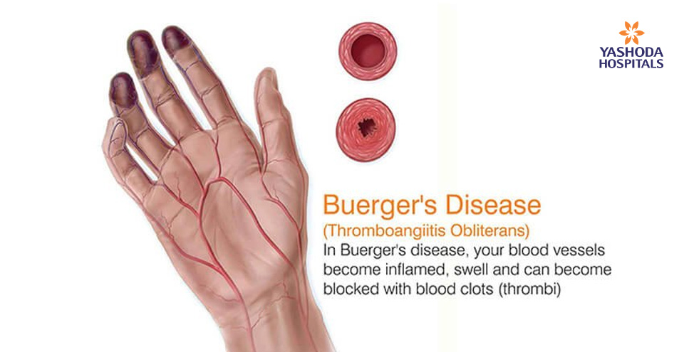 What is Buerger’s disease ? Causes, Symptoms, Risk & Complications !