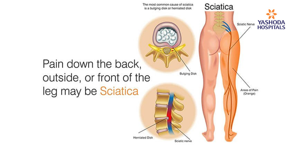 How to diagnose and treat Sciatica?