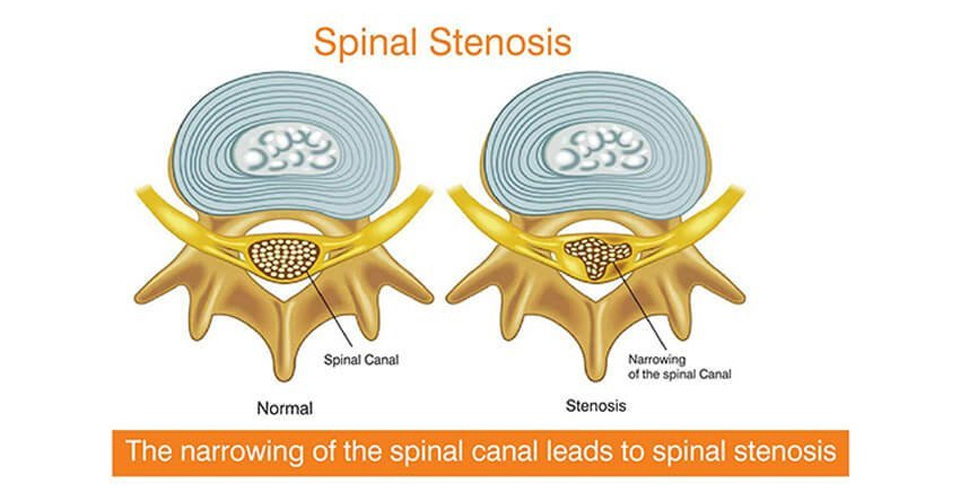 Lumbar and Cervical Spinal Stenosis