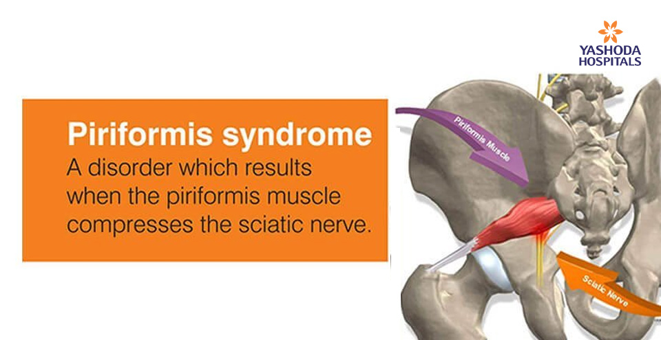 How to diagnose and treat Piriformis Syndrome?