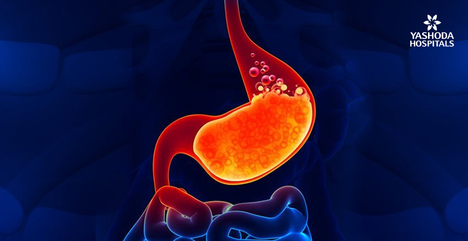 Acid Reflux Disease