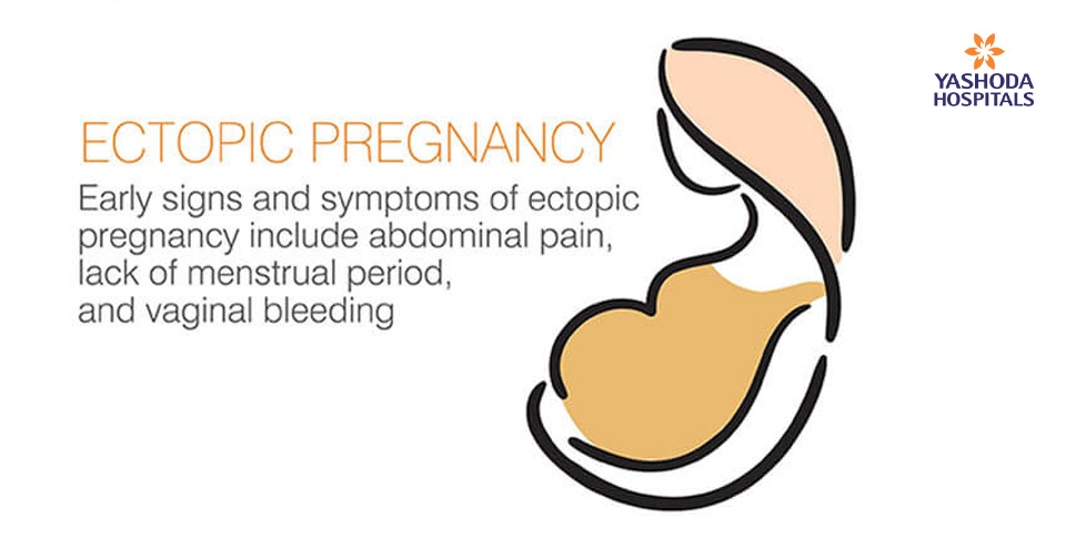 Ectopic Pregnancy