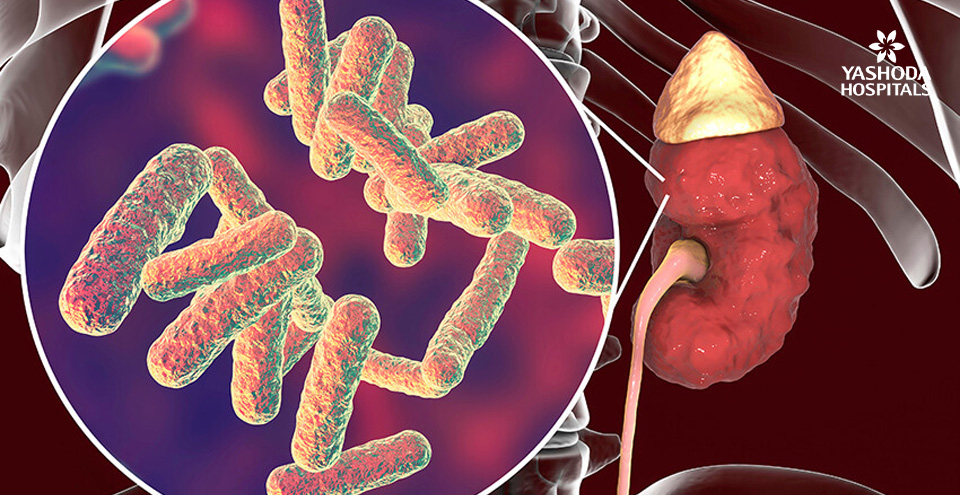 Hemolytic Uremic Syndrome (HUS)