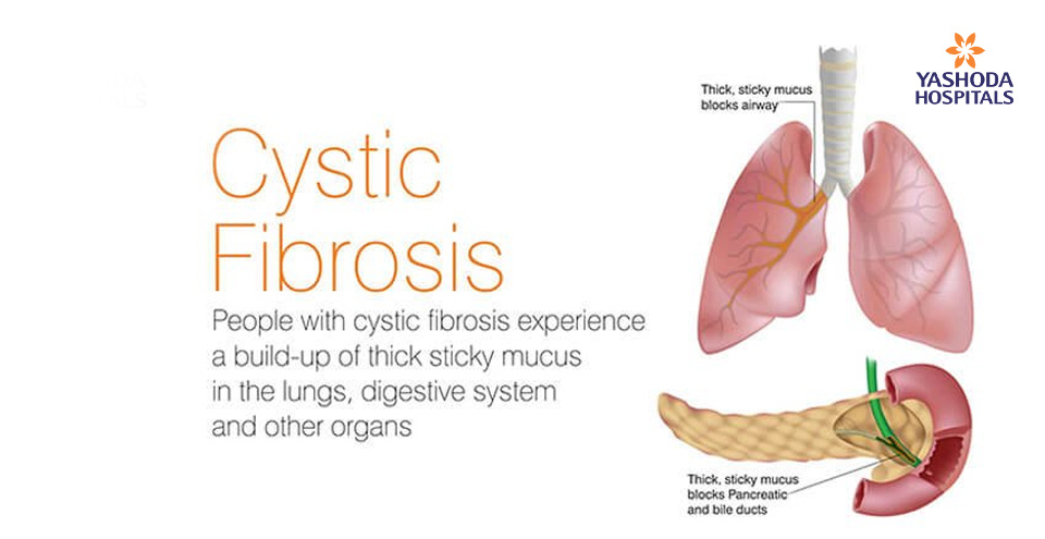 Cystic Fibrosis