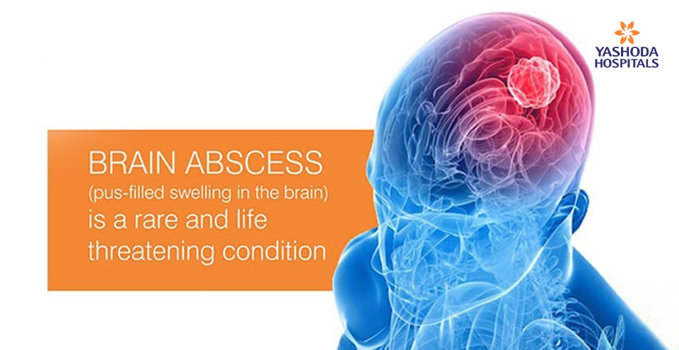 Brain Abscess