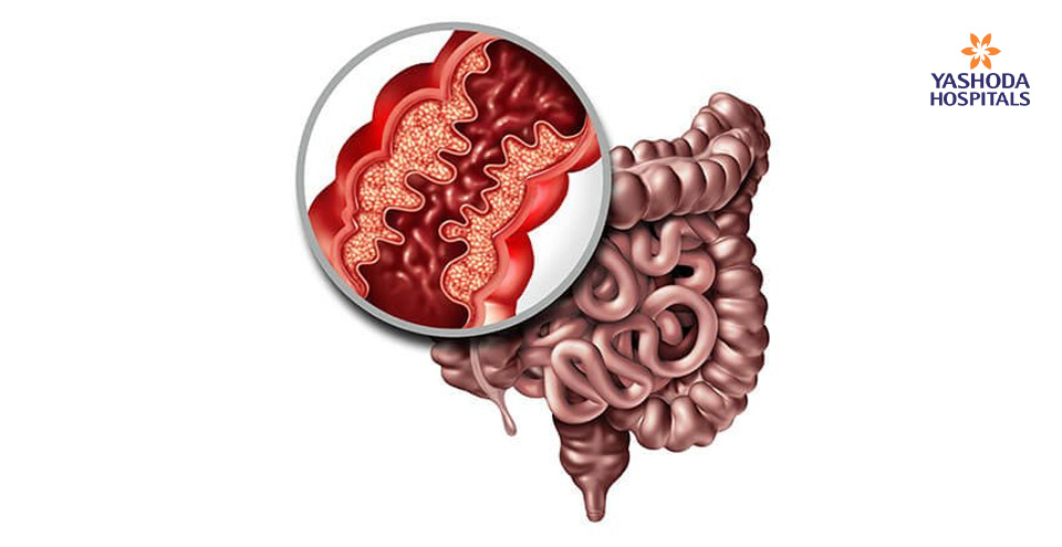 Crohns Disease