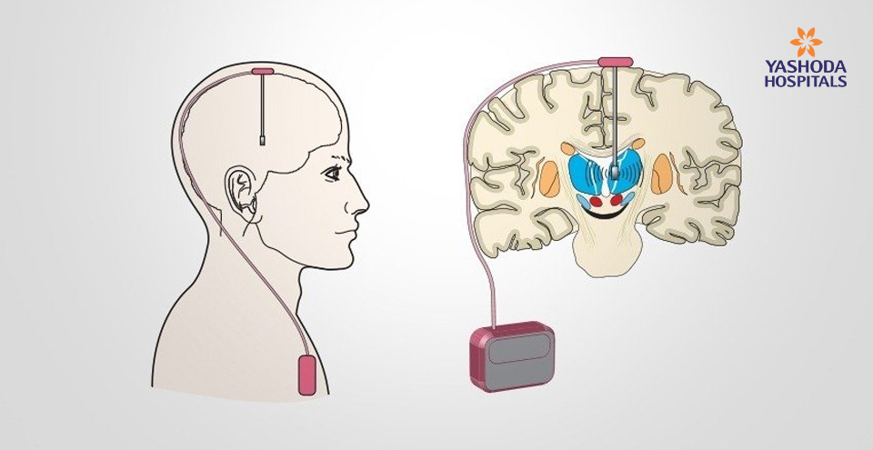 How to treat Parkinson’s Disease using Deep brain stimulation?