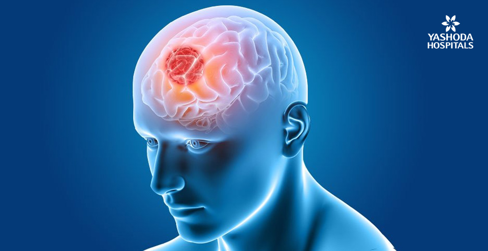 Understanding brain tumours