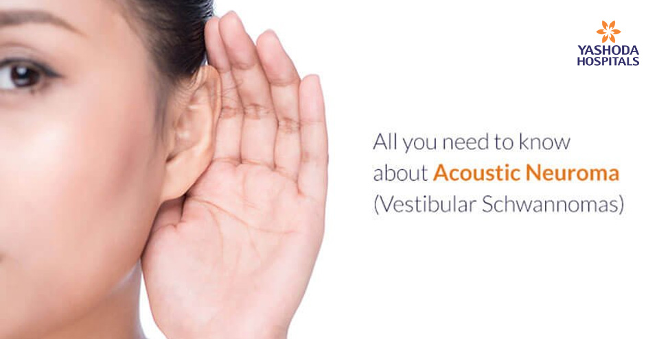 Acoustic Neuroma – Important Things To Know About