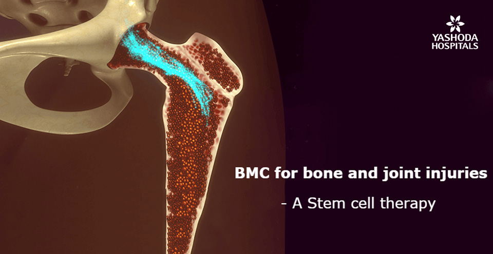 Bone Marrow Concentrate (BMC), a regenerative therapy for bone and joint injuries