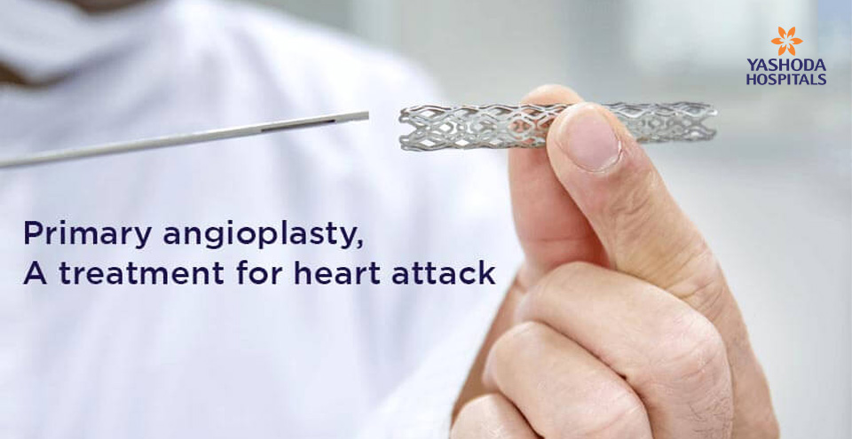 Primary angioplasty for Acute Myocardial infarction