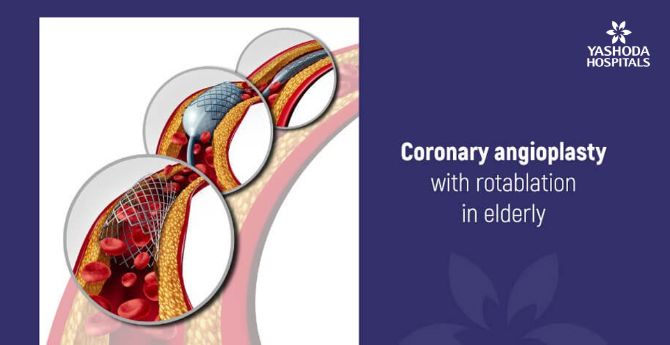 Coronary angioplasty with rotablation in elderly