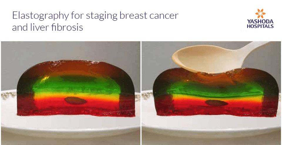 Elastography – A promising tool for staging of breast cancer and liver diseases