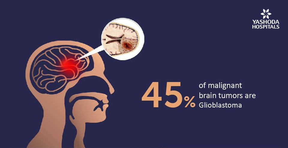 What is the most aggressive form of glioma? Is there a complete cure?