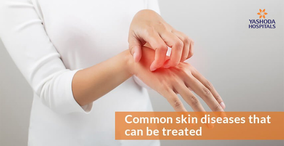 4 treatable skin diseases: dermatitis, eczema, psoriasis, skin cancer