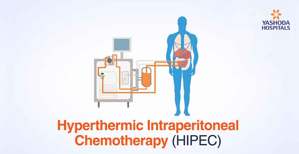 HIPEC – Chemotherapy redefined