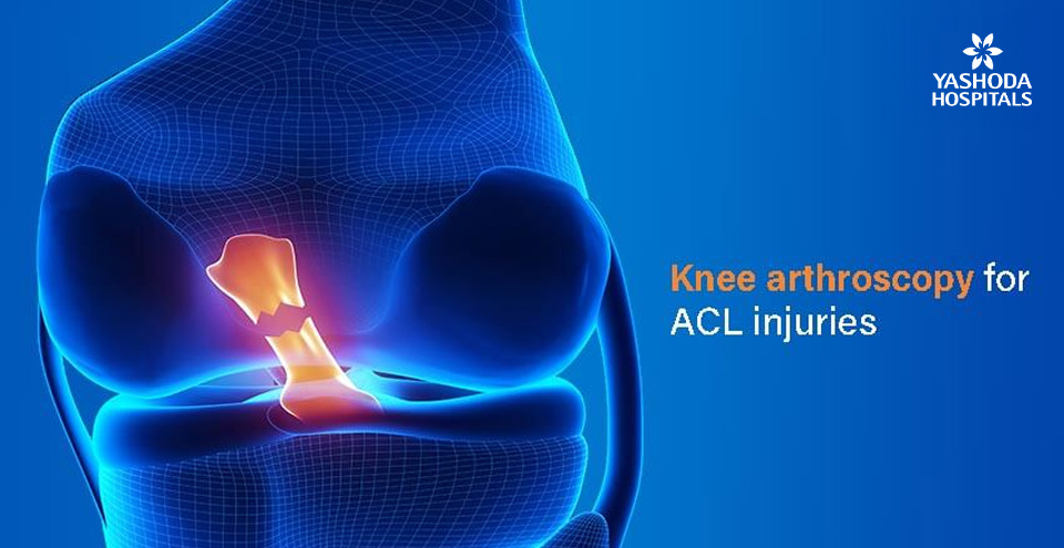 Anterior Cruciate Ligament (ACL) injury – Role of Arthroscopy