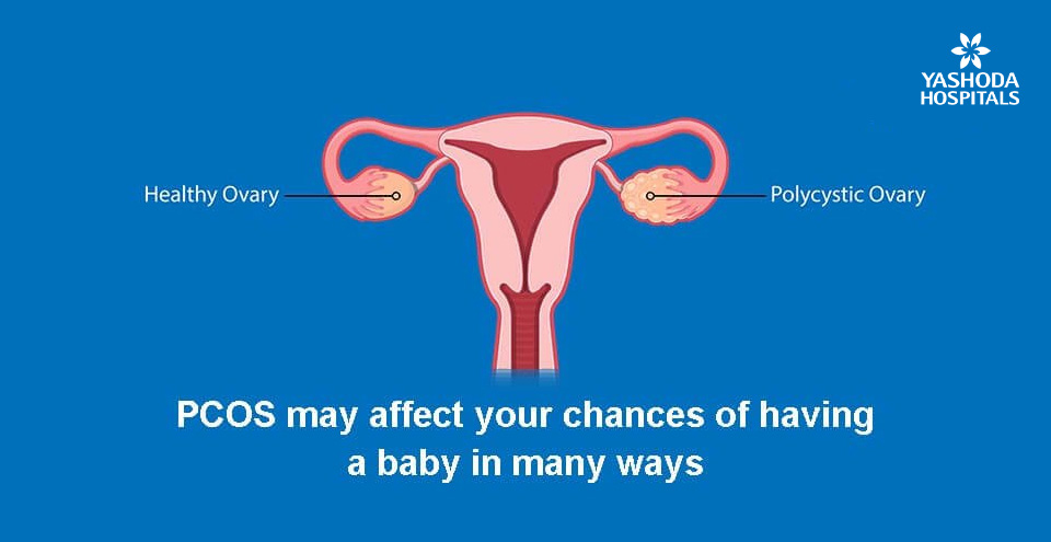 How does PCOS affect female fertility?