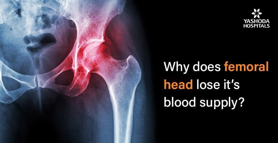 Why does the femoral head lose its blood supply?