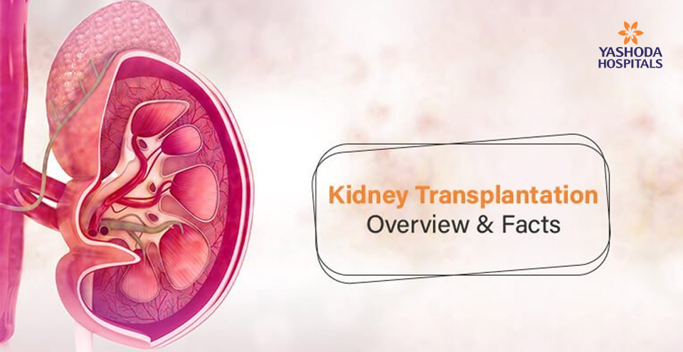 Frequently asked questions about kidney transplant